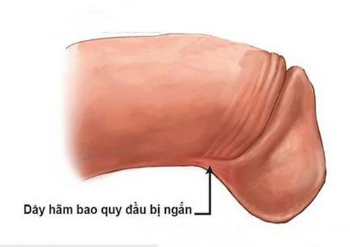 Dây hãm bao quy đầu và các vấn đề liên quan
