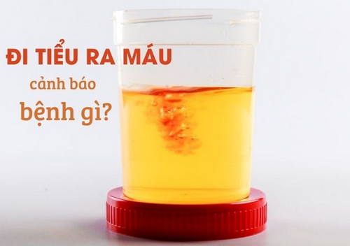 Đi tiểu ra máu là bị làm sao? Top bệnh lý nguy hiểm thường gặp