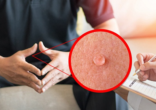 Mụn cóc sinh dục HPV mọc ở đâu? Cách điều trị hiệu quả