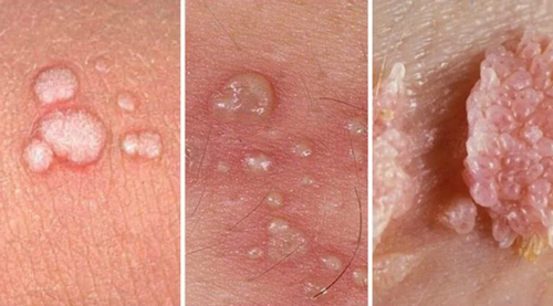Nhận biết giai đoạn bệnh sùi mào gà thông qua các dấu hiệu bệnh lý