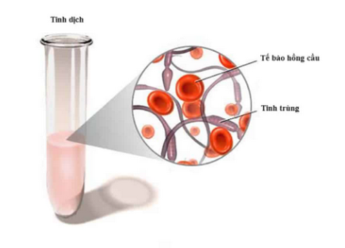 Nhận biết tinh trùng có máu và thăm khám bệnh hiệu quả