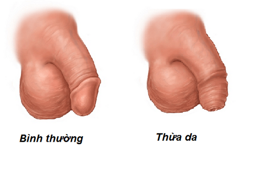 Quy trình cắt bao quy đầu bằng công nghệ xâm lấn tối thiểu Hàn Quốc