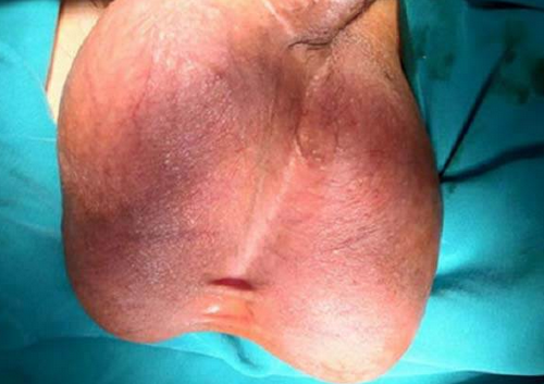 Sưng bìu tinh hoàn cảnh báo các vấn đề về sức khỏe nguy hiểm