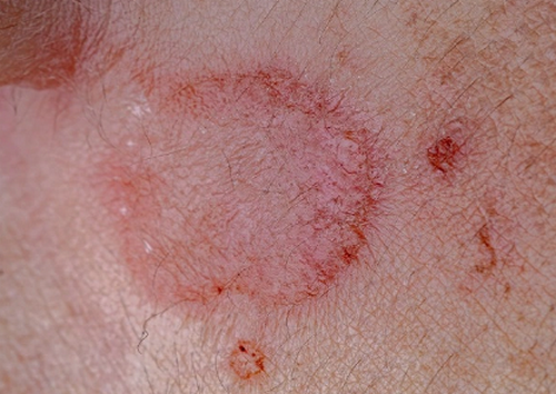 Tìm hiểu về giang mai giai đoạn 1 và các biến chứng của bệnh