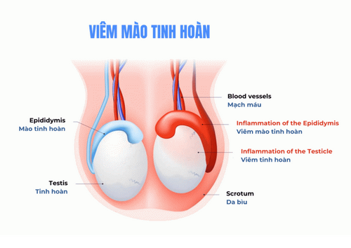 Vêm mào tinh hoàn: Nguyên nhân, dấu hiệu và cách điều trị hiệu quả
