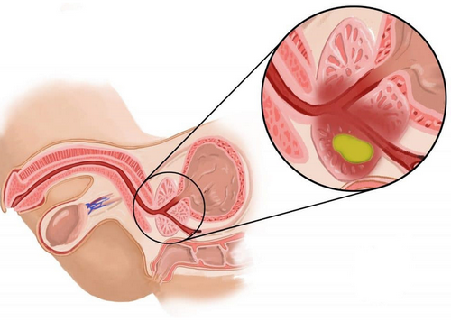 Viêm tuyến tiền liệt: Nguyên nhân, dấu hiệu và cách điều trị