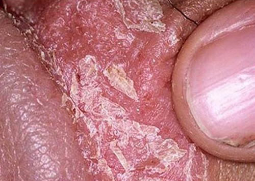 Bao quy đầu bị mốc trắng kèm mùi hôi ngứa là bị bệnh gì?