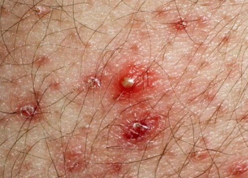 Cảnh báo mụn mủ vùng kín nam giới và các vấn đề liên quan