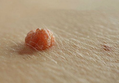 Gốc dương vật nổi mụn ngứa ngáy khó chịu làm ảnh hưởng đến nam giới