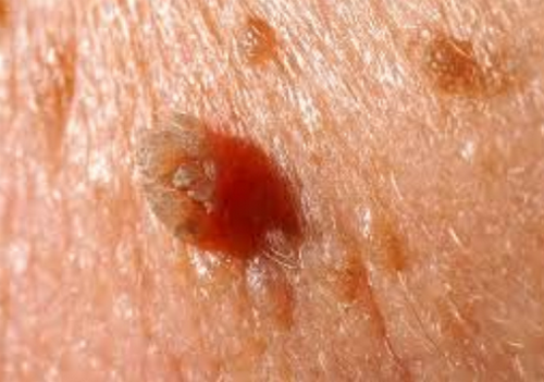 Sùi mào gà ở dương vật: Nguyên nhân, dấu hiệu và cách điều trị