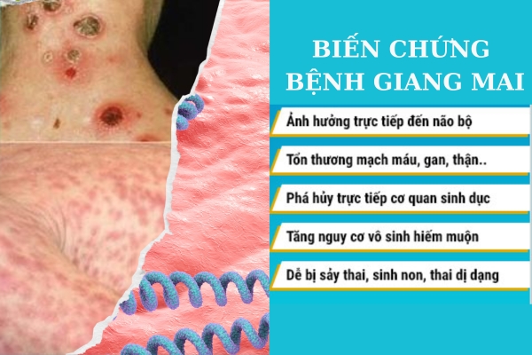Các triệu chứng bệnh giang mai điển hình cần đi khám ngay lập tức 15