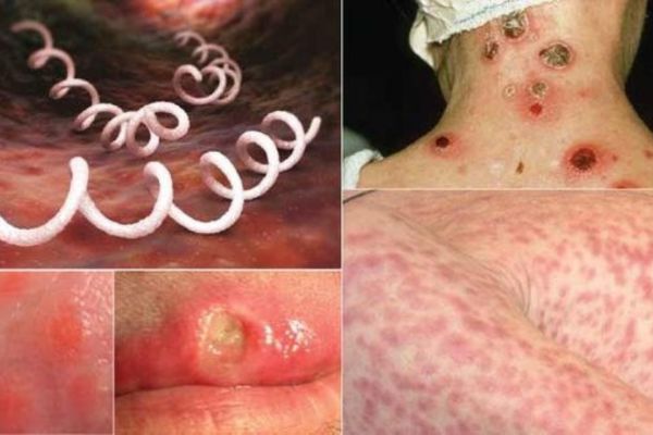 Xoắn khuẩn giang mai có thể ảnh hưởng đến hệ thần kinh, gây tử vong