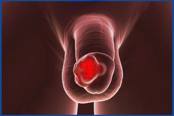 Biến chứng sùi mào gà ở bìu tinh hoàn