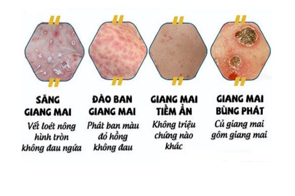 Các giai đoạn của bệnh giang mai ở nam giới