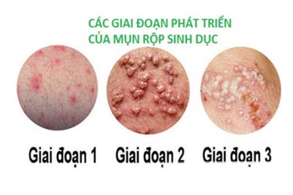 Dấu hiệu bệnh mụn rộp sinh dục ở nam giới và tác hại nguy hiểm của bệnh 19