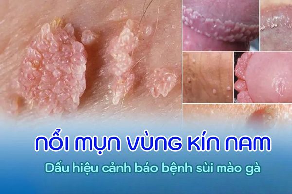 Nổi mụn vùng kín nam là biểu hiện bệnh sùi mào gà