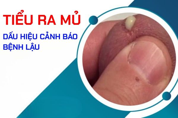 Tiểu ra mủ ở nam giới - Dấu hiệu cảnh báo bệnh lậu